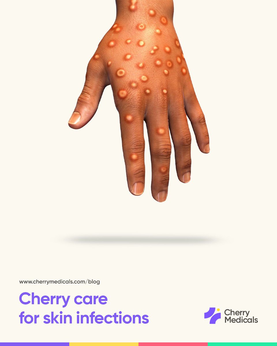 CherryMedicals's tweet photo. Blog post available on our website.
See link below👇
https://t.co/nJVP0S3g46

#skininfection #skininfectiontreatment #blogpost #healthblog #homemedicalservice #homecareagency https://t.co/h7xynziyx3
