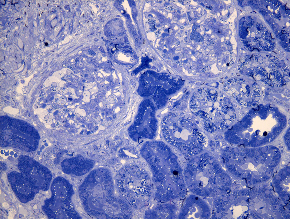 ChangUCanSpare's tweet photo. Enjoy these amazing images from this Toluidine blue stain #renalpath #electronmicroscopy

Courtesy of @hawkssox (first time I've ever seen an actual case of this entity) https://t.co/0B8o30qGtd