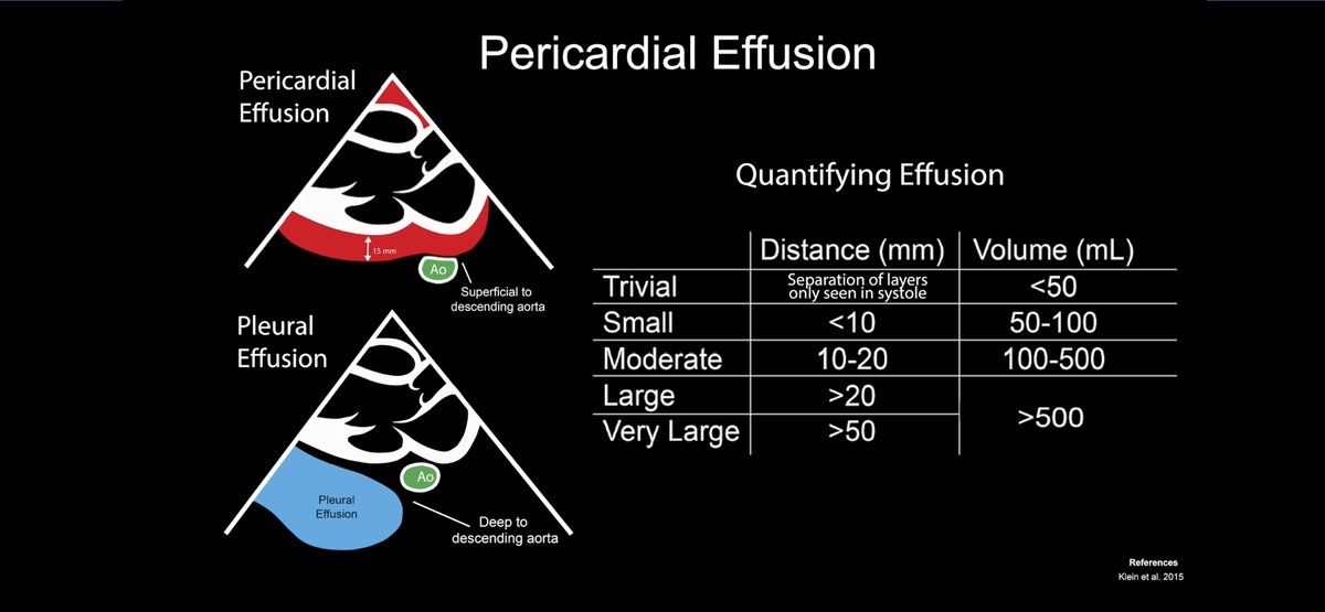 Dan Kim (@dan___kim) on Twitter photo More from the <a href="/ACEP_EUS/">ACEP Ultrasound</a> critical care subcommittee advanced echo cards (<a href="/lataylor1218/">Lindsay Taylor</a> & <a href="/EDechographer/">Zan Jafry</a>)
How to distinguish pericardial effusion from pleural effusion on #echo #pocus
acep.org/emultrasound/s… More from the <a href="/ACEP_EUS/">ACEP Ultrasound</a> critical care subcommittee advanced echo cards (<a href="/lataylor1218/">Lindsay Taylor</a> & <a href="/EDechographer/">Zan Jafry</a>)
How to distinguish pericardial effusion from pleural effusion on #echo #pocus
acep.org/emultrasound/s…