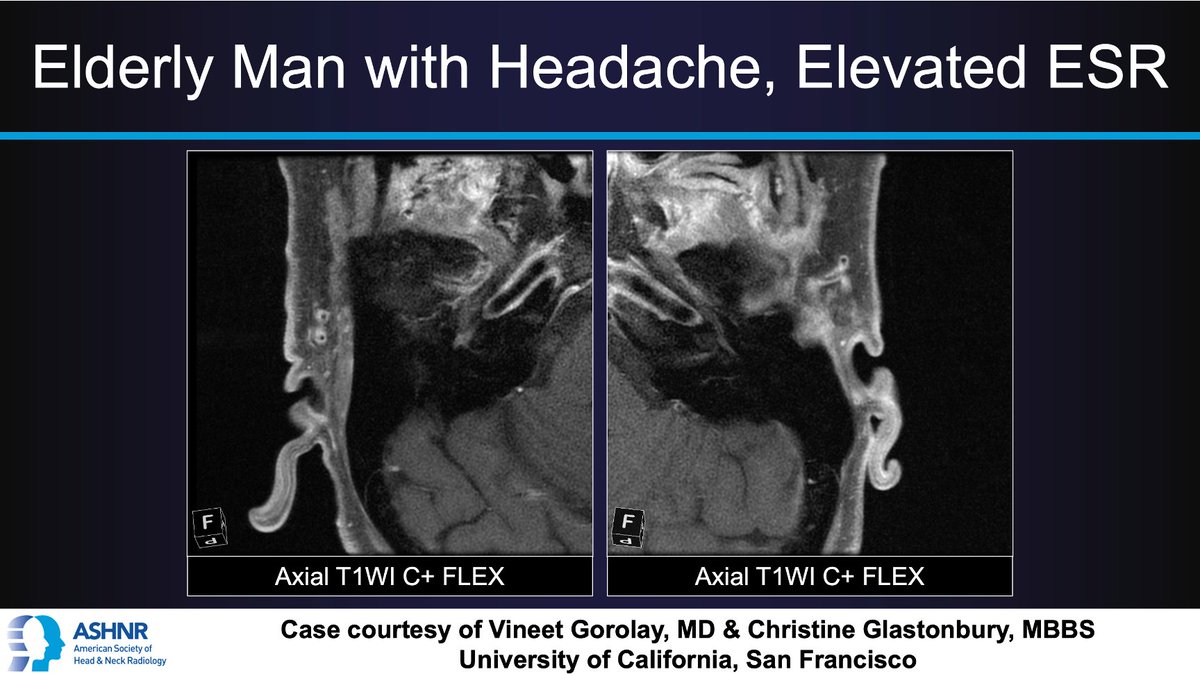 #ASHNRCOTW #204: Elderly man w/ headache, elevated ESR. Dx? Thx Drs. Gorolay & @CMGlastonbury 4 case! #ASHNR23 Answer w/ appropriate GIF only -- stay professional & don't spoil it! @callyrobs @DShatzkes @CDP_Rad @rhwiggins @nakoontz @cmtomblinson @WmOBrienDO @ESHNRSociety