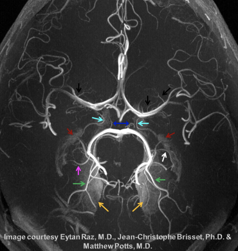 cvsection's tweet photo. The posterior limb of the internal capsule (#PLIC) is supplied by the #anterior #choroidal artery (light blue arrow on a 7T contrast-enhanced MRI from @neuroangio1) #cerebrovascular #neuroanatomy
#MedStudents: what sx would a stroke to this artery cause? https://t.co/059mzrQc1s https://t.co/hi9Y2AzZff