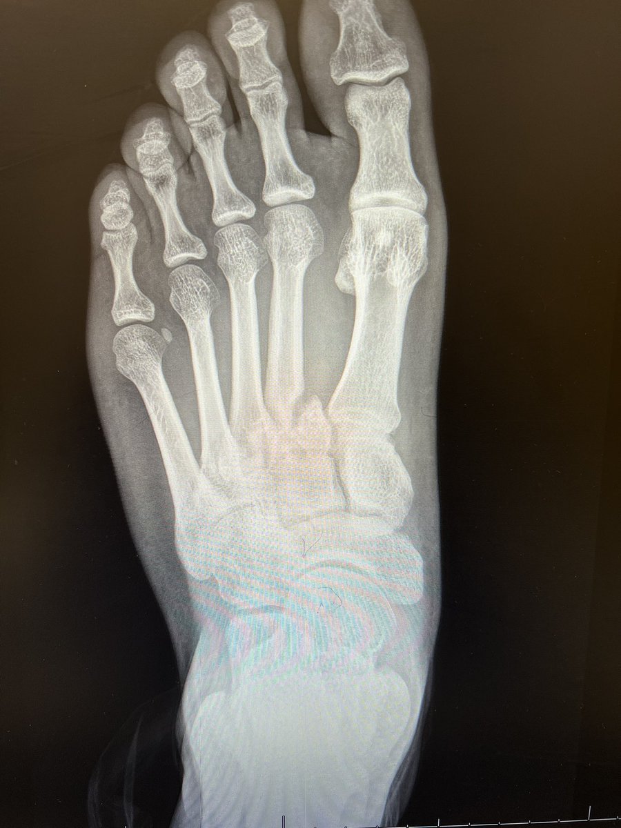 MedorthoMs's tweet photo. 37 years old active male came to my clinic with chronic midfoot pain . He sustained this injury 8 months back , and was treated conservatively by other colleagues.
@BostonFootAnkle @FootAndAnkleMD @pmangoneMD https://t.co/eA0tAnX1cI