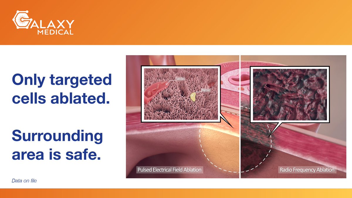 With the CENTAURI PEF System, electrophysiologists can treat patients without unnecessary damage to surrounding tissue.

The CENTAURI PEF System is not available for sale in the US.

Learn more: galaxymed.com/galaxy-medical…

#Cardiology #Electrophysiology #EPLab #EPeeps #CardioEd