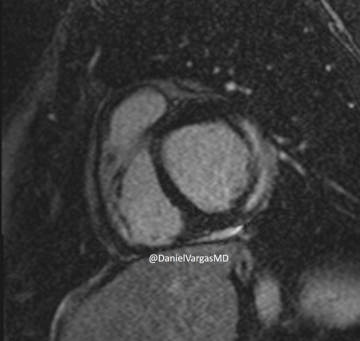 Daniel Vargas, MD (@danielvargasmd) on Twitter photo A Lake Louise type of a day! A nice example of myocarditis in this young patient. #radres #WhyCMR
<a href="/NASCISociety/">NASCI</a> <a href="/KateHanneman/">Kate Hanneman</a> <a href="/Camiurzua/">Camila Urzúa Fresno</a> <a href="/LopezOpitz/">J.Lopez-Opitz@CardioImagen_cl</a> <a href="/ecocardio_cl/">Julián Vega Adauy</a> <a href="/danilorenzatti/">Daniel Lorenzatti, MD.</a> <a href="/TLHM_MD/">Tan-Lucien Mohammed, MD, FACR</a> <a href="/AshleyEProsper/">Ashley Prosper, MD</a> <a href="/JoannaEscalonMD/">Joanna Escalon, MD</a> <a href="/kirschj/">Jacobo Kirsch, MD, MBA, FACR</a> <a href="/EricWillMD/">Eric Williamson</a> <a href="/CsFuss/">Dr. Cristina Fuss</a> A Lake Louise type of a day! A nice example of myocarditis in this young patient. #radres #WhyCMR
<a href="/NASCISociety/">NASCI</a> <a href="/KateHanneman/">Kate Hanneman</a> <a href="/Camiurzua/">Camila Urzúa Fresno</a> <a href="/LopezOpitz/">J.Lopez-Opitz@CardioImagen_cl</a> <a href="/ecocardio_cl/">Julián Vega Adauy</a> <a href="/danilorenzatti/">Daniel Lorenzatti, MD.</a> <a href="/TLHM_MD/">Tan-Lucien Mohammed, MD, FACR</a> <a href="/AshleyEProsper/">Ashley Prosper, MD</a> <a href="/JoannaEscalonMD/">Joanna Escalon, MD</a> <a href="/kirschj/">Jacobo Kirsch, MD, MBA, FACR</a> <a href="/EricWillMD/">Eric Williamson</a> <a href="/CsFuss/">Dr. Cristina Fuss</a>