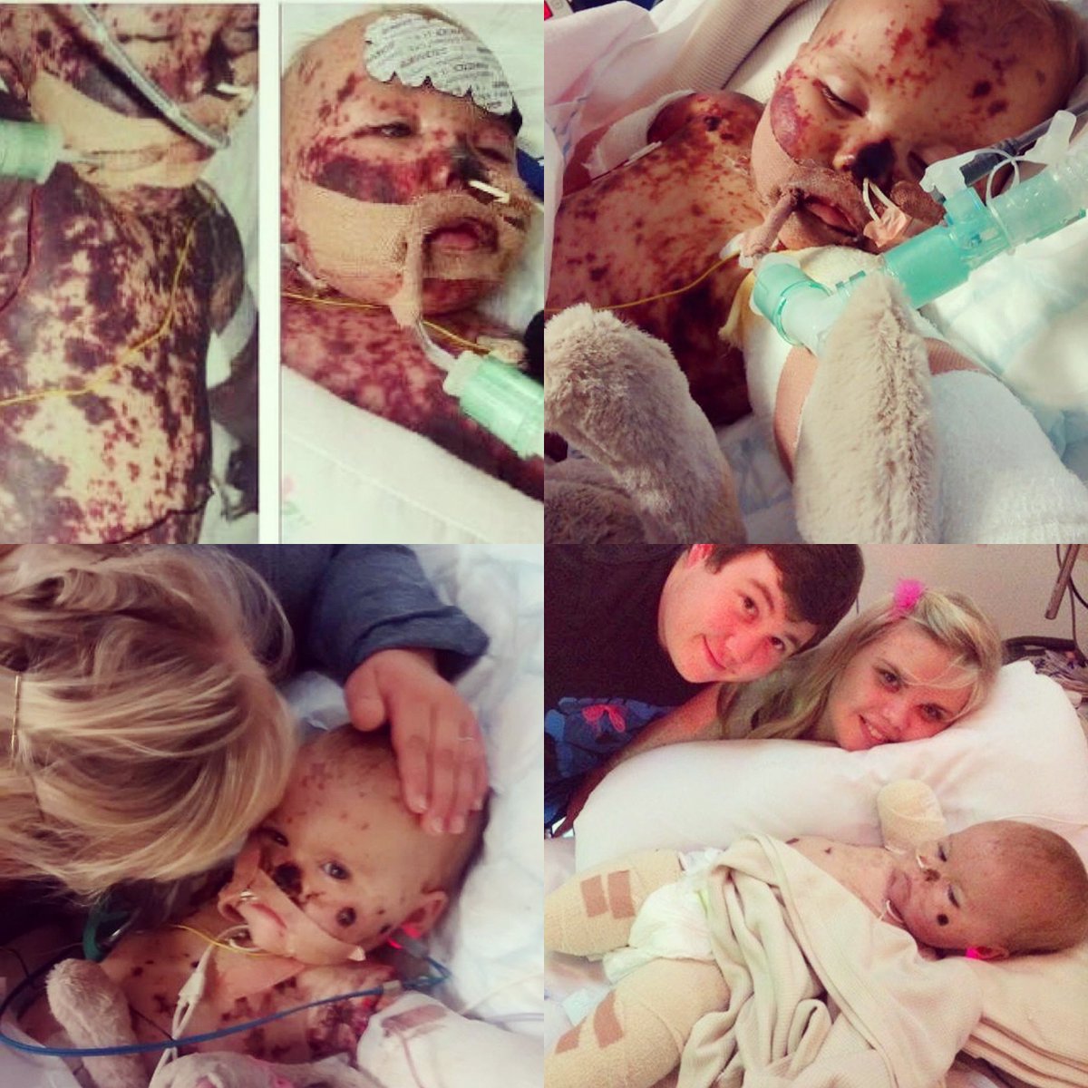 Meningitis awareness day, be aware, know the signs and symptoms…. meningitisnow.org/meningitis-exp…

You always think it won’t be you…. We thought that too… #meningitisawareness