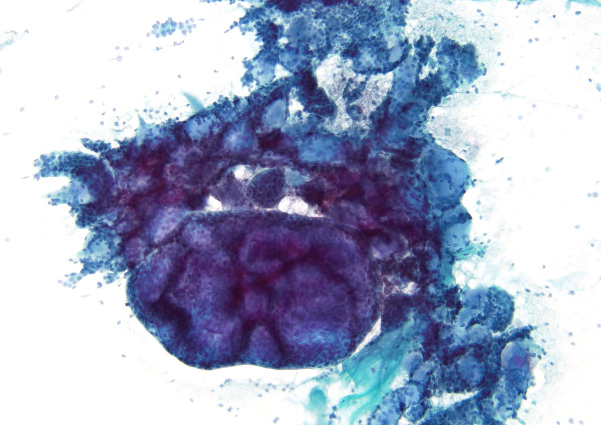 CLASSIC appearance (even on a Pap stain) - 'Adenoid Cystic Carcinoma', Submandibular Gland FNA.