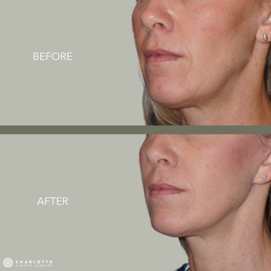YouRenewedCLT's tweet photo. A #minifacelift is less invasive, has smaller incisions, and has a shorter recovery time than a traditional #facelift. They are a popular option among younger patients who simply want some minor skin tightening. #charlottenc https://t.co/2KiSDe1wjI
