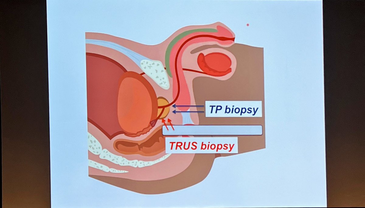 Comprehensive review of TP biopsy technique, including LA option, free-hand vs guide-directed, fusion techniques including automation/robotics - urging TRUS biopsy to be phased out @jteoh_hk #UAA2022