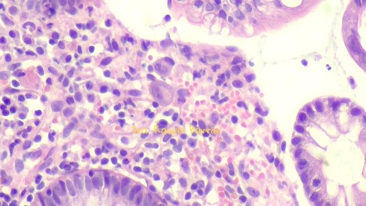 The day came when I found it.  Cytomegalovirus colitis, 48-year-old male. #PathTwitter #pathresidents #path