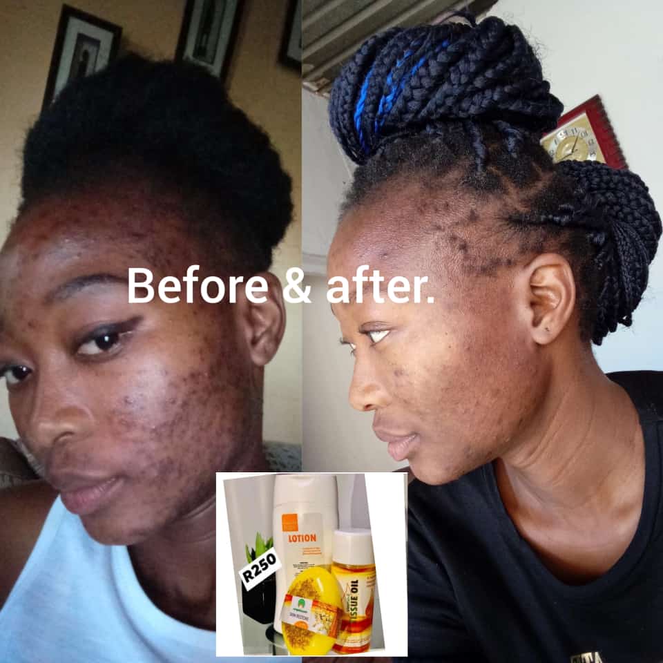k_mkhensi's tweet photo. If you know someone struggling with pimples, acne, eczema, itchy skin blemishes, stretchmarks, dry skin, dark marks or burns, ringworms, amafusi, nsumpa, amathumba, bleeding gums and teeth, sore throat, I recommend Umgalelo #etvScandal #Mnakwethu #Candice #MusaKhawula #Seemah https://t.co/sk6lStwG3b