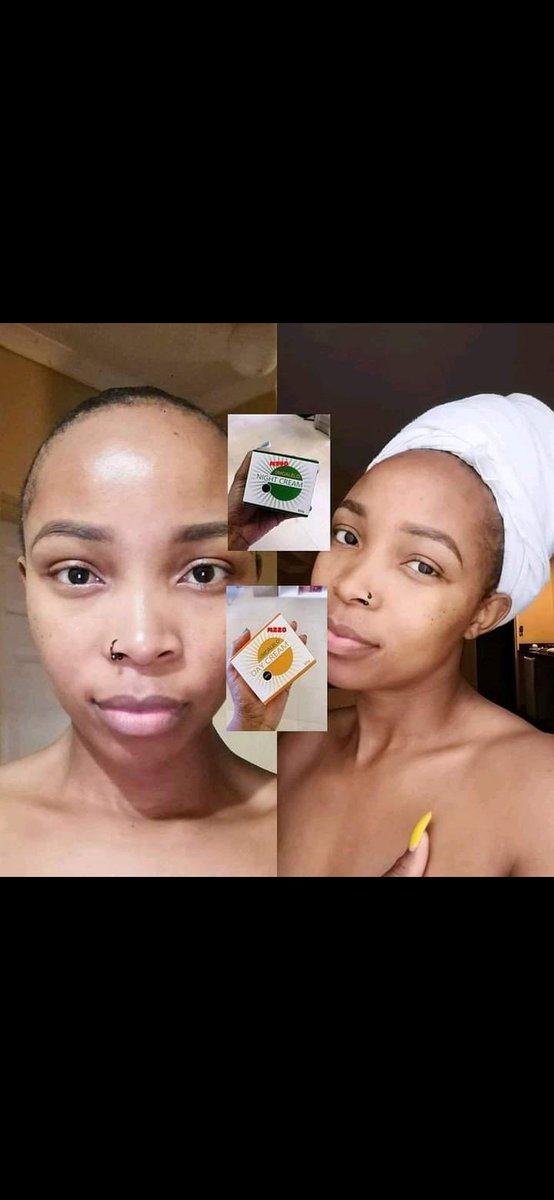 k_mkhensi's tweet photo. If you know someone struggling with pimples, acne, eczema, itchy skin blemishes, stretchmarks, dry skin, dark marks or burns, ringworms, amafusi, nsumpa, amathumba, bleeding gums and teeth, sore throat, I recommend Umgalelo #etvScandal #Mnakwethu #Candice #MusaKhawula #Seemah https://t.co/sk6lStwG3b
