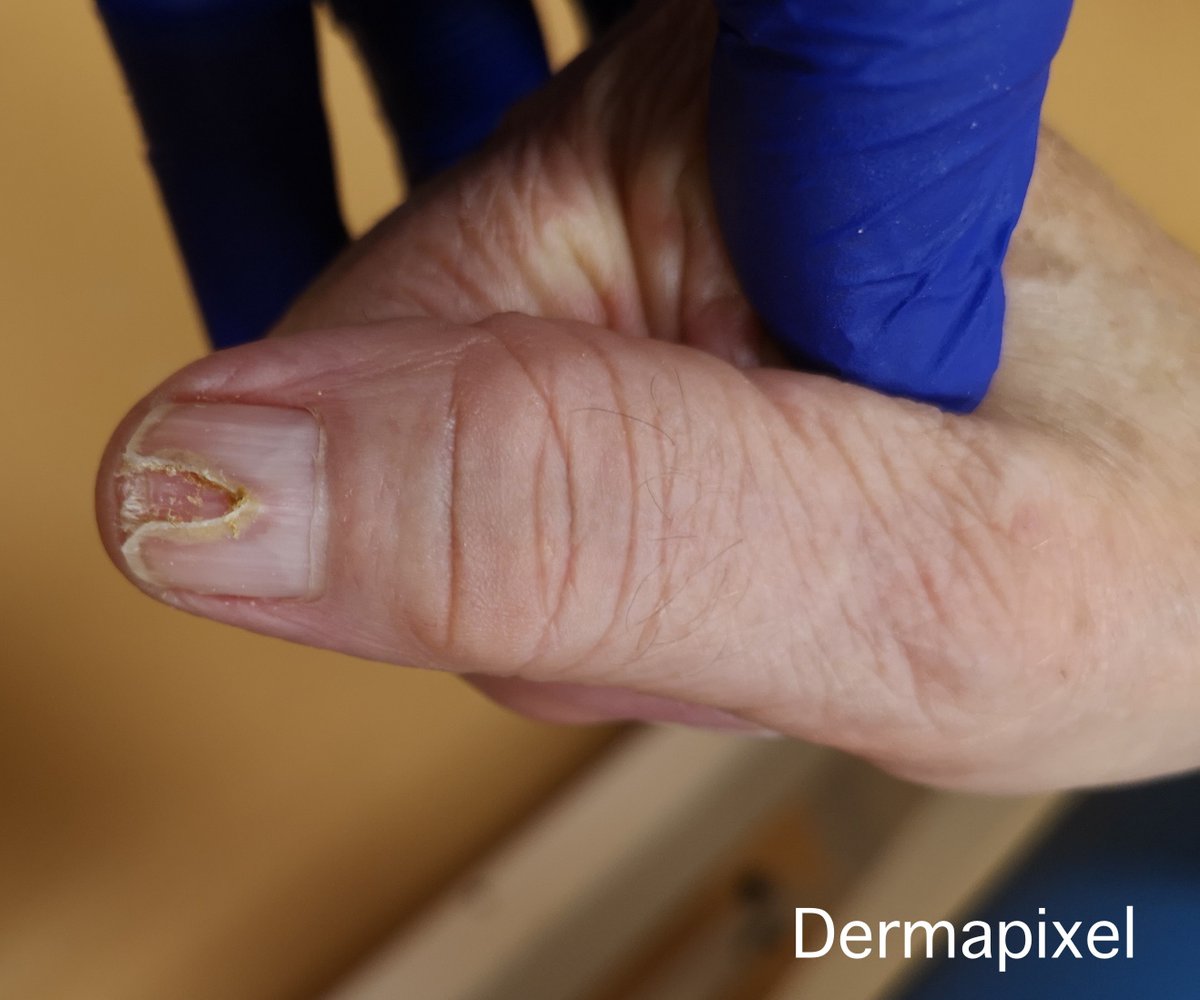 Dermatofitoma: a veces los hongos en las uñas son así, y no vale el tratamiento de siempre.
Hoy en <a href="/dermapixel/">Dermapixel</a>, caso gentileza de <a href="/JuanJCauhe/">Juan Jiménez Cauhé</a> 
dermapixel.com/2022/10/dermat… #dermatología #dermtwitter