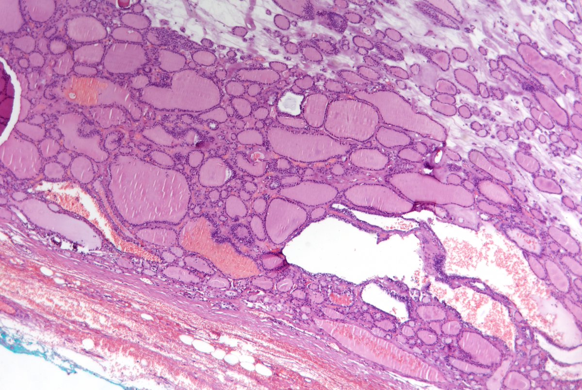 Andrew_Fltv's tweet photo. Dx: Parasitic nodule vs ectopic thyroid tissue with recurrent multinodular goiter.
2/3
#EndPath #Grossognosis #pathoutpic https://t.co/xBVkfFi5sT