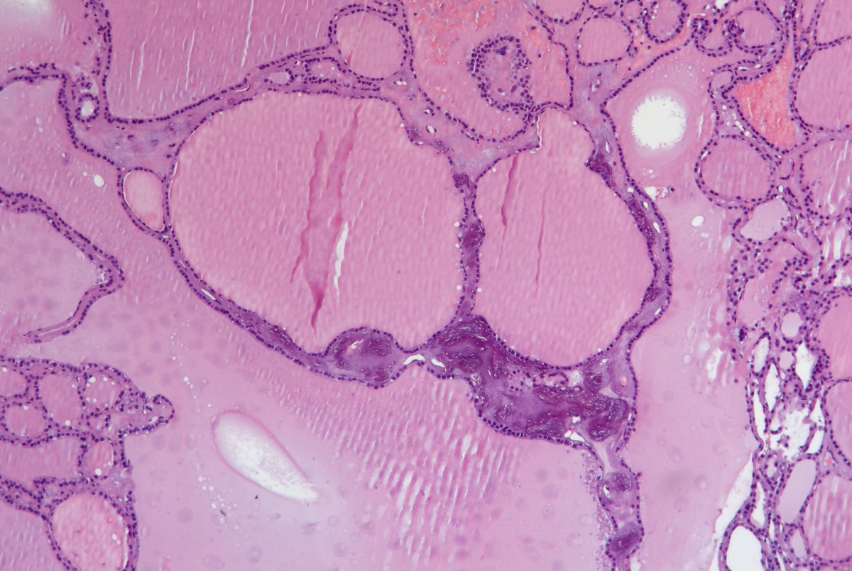 Andrew_Fltv's tweet photo. Dx: Parasitic nodule vs ectopic thyroid tissue with recurrent multinodular goiter.
2/3
#EndPath #Grossognosis #pathoutpic https://t.co/xBVkfFi5sT