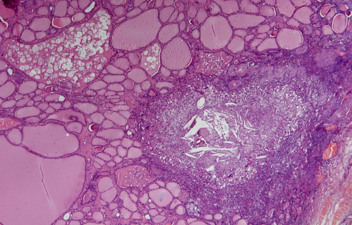 Andrew_Fltv's tweet photo. Dx: Parasitic nodule vs ectopic thyroid tissue with recurrent multinodular goiter.
2/3
#EndPath #Grossognosis #pathoutpic https://t.co/xBVkfFi5sT