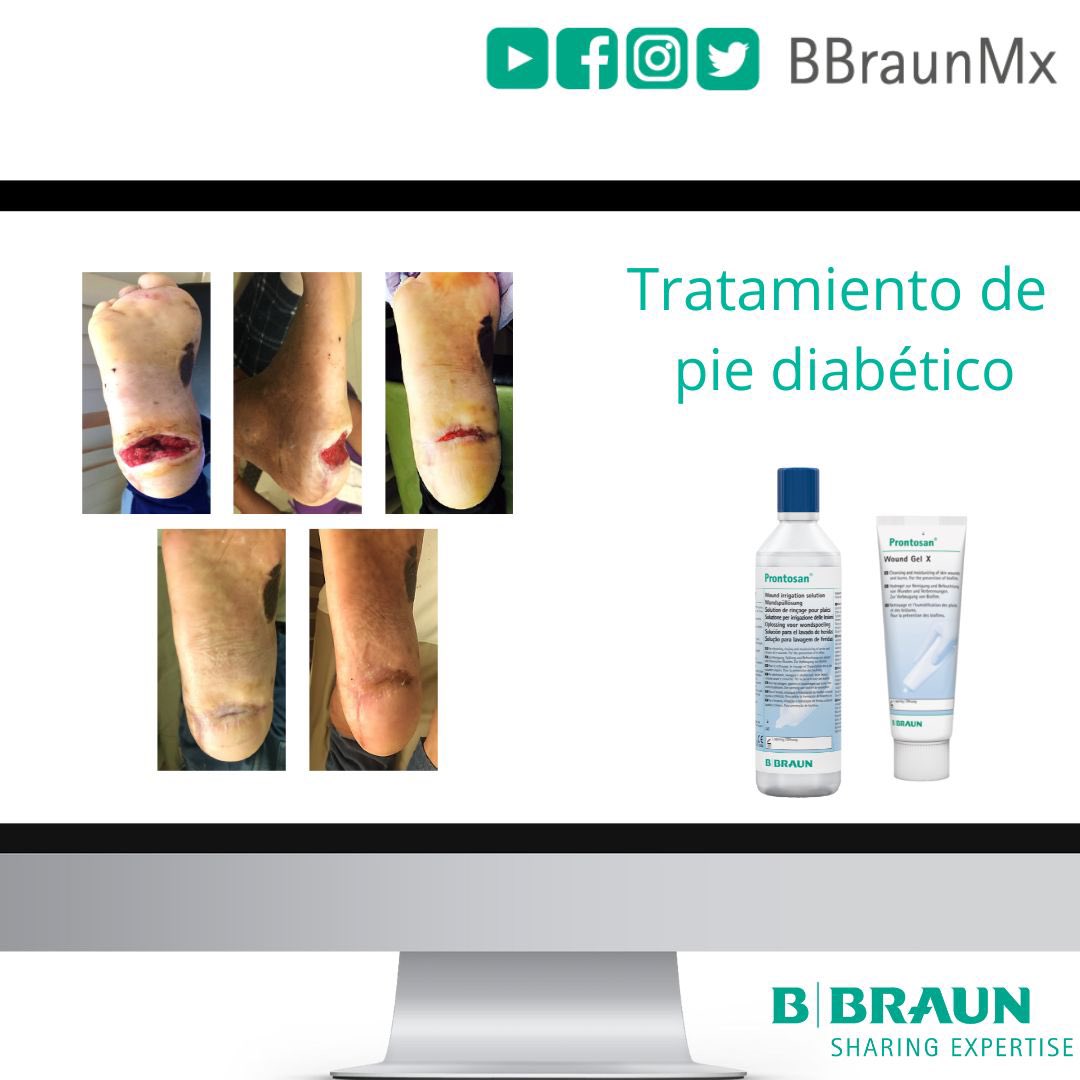 UlcerasMexico's tweet photo. Prontosan® para la prevención y tratamiento de la infección en heridas. https://t.co/qkI7pc9Z6i