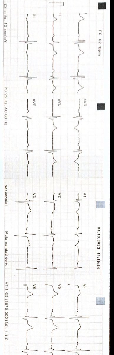 diegopserranop's tweet photo. Estimulación Septal Profunda #LeftBundleBranchPacing #Huang @SIAC_cardio @LAHRSonline1 @drjosellorente @DiegoEgas1 @JavierPinosV1 @jczerpa @drgomezmacias @AlkmimRicardo @BellottiHugo @ArritmiasSec https://t.co/jzgbBIBvVn
