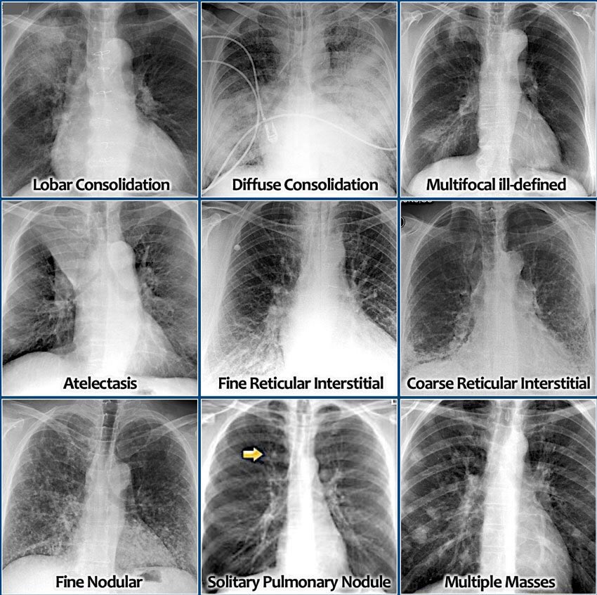 drromanpathak's tweet photo. Useful X-ray pictures showing pulmonary disorders https://t.co/1fveJiBMA9
