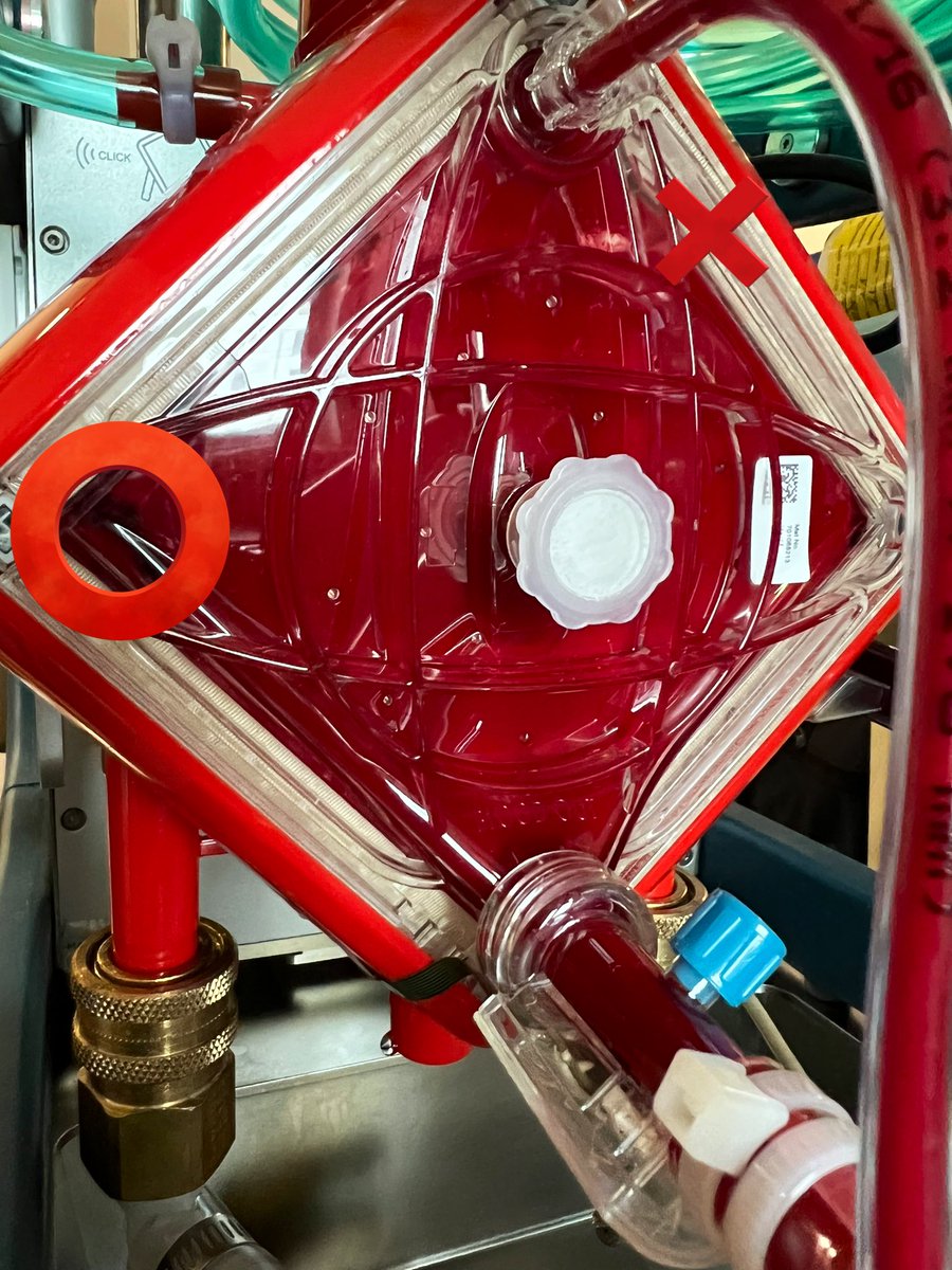Bindu Akkanti, MD. (@akkanti) on Twitter photo ECMO management #MCSCriticalCare pearls
Clots on the post oxygenator side
✅ check ur post-oxygenator gas
✅ that’s ur equivalent of checking A-a gradient
✅ address/change the anticoagulation and change circuit
<a href="/McGovernPulmCC/">UT Pulmonary Critical Care Sleep</a> ECMO management #MCSCriticalCare pearls
Clots on the post oxygenator side
✅ check ur post-oxygenator gas
✅ that’s ur equivalent of checking A-a gradient
✅ address/change the anticoagulation and change circuit
<a href="/McGovernPulmCC/">UT Pulmonary Critical Care Sleep</a>