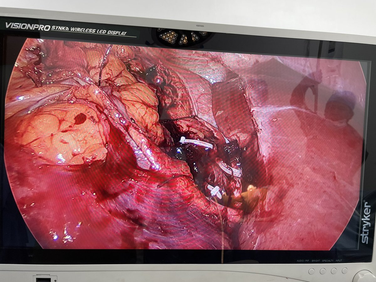 VcntKno's tweet photo. Starting to use the new learned techniques at @UrologyHucad 🇵🇹 w/ Prof @nunodomingues87 @parada_belmiro @shekharbiyani 

Male 49yo sole kidney w/45mm mass 
#zeroischemia #UroSoMe @Uroweb @colmexuro @so_uro @CAU_URO @AmerUrological https://t.co/9M7UiIfKPg
