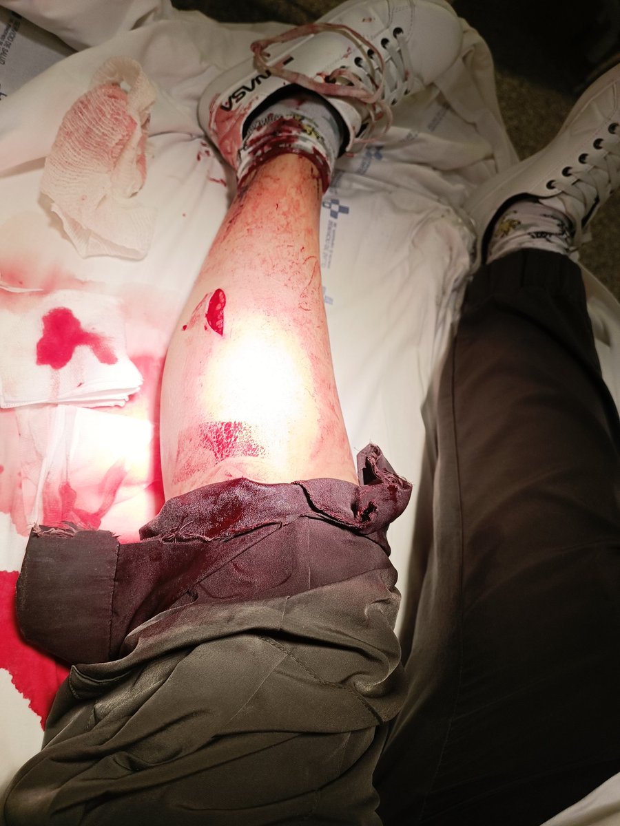 embajada_civica's tweet image. Anoche intervine en una agresión/persecución a una chica joven. La agresora (joven desconocida por ambas) apuñaló mi pierna izq. Me recuperaré, de todo. El punto está en que chica agrede chica y una mujer ayuda a la víctima. La violencia no tiene género, y si mi rechazo absoluto!