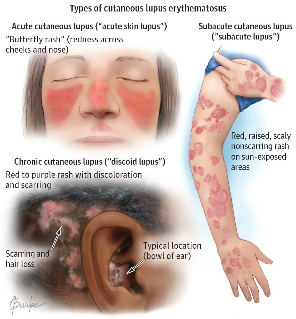 Discoid Lupus Erythematosus