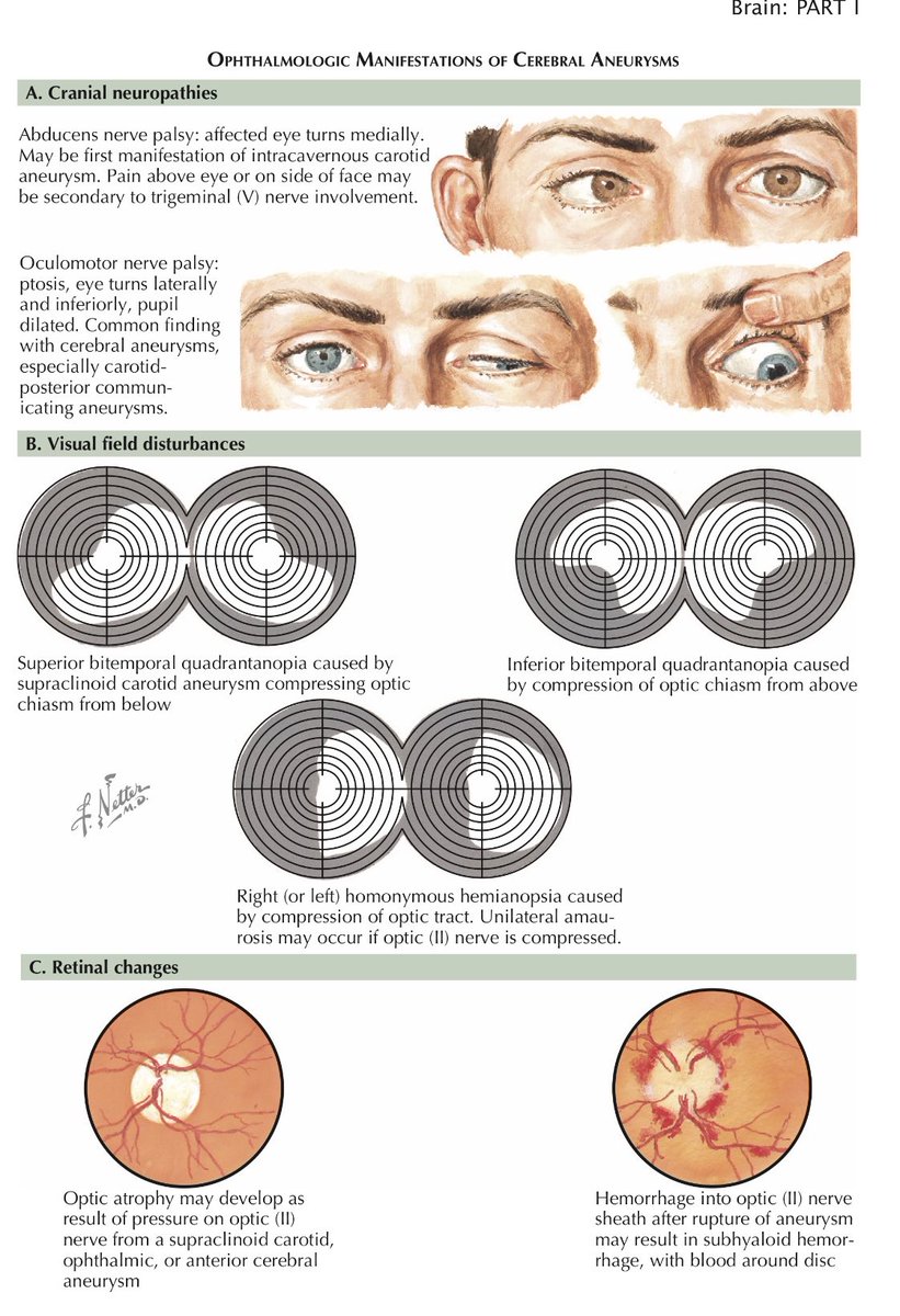 Don’t forget to check the eyes. #OPHTHALMOLOGIC manifestations of brain  aneurysms and ruptures. #neurosurgery #neurotwitter