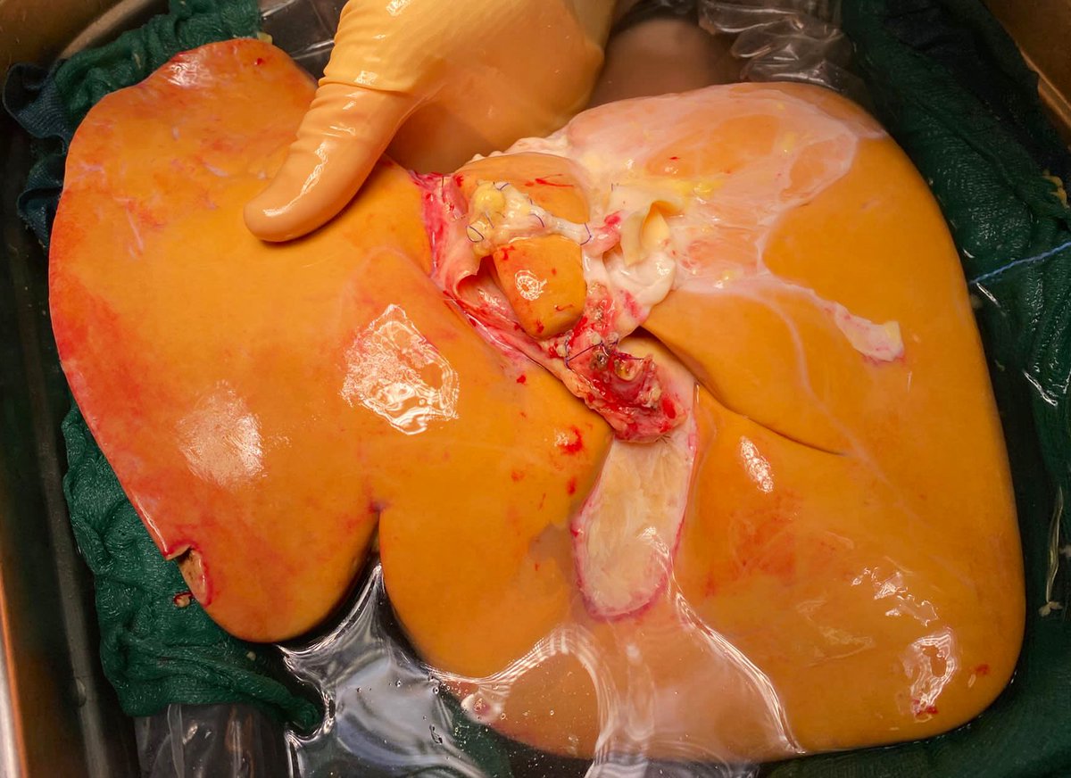 DeCarlis_R's tweet photo. How we spent our yesterday evening @IvanVella91 @Sa92_10:

✅ accept a #liver discarded by another center during recovery (MaS 60-70%, miS 30-40%)
✅ repair a damaged LHA from the LGA
✅ evaluate the liver on #NMP (lac 1 at 1h)
✅ #transplant the liver

https://t.co/GJyyUnlItg https://t.co/hKqXsZbPce