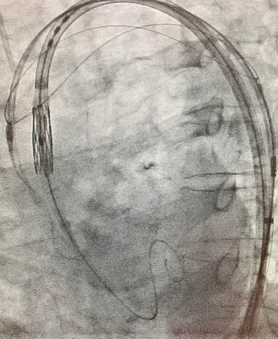 CARDIVAGROUP's tweet photo. El H. Dr. Nélio Mendonça realiza su primer implante #TAVI con #protecciónembólicacerebral completa de los tres vasos supra-aórticos con el dispositivo de #KeystoneHeart y se convierte en el primer centro insular portugués en hacer este procedimiento con el dispositivo
#ACV https://t.co/XScWc96lwM