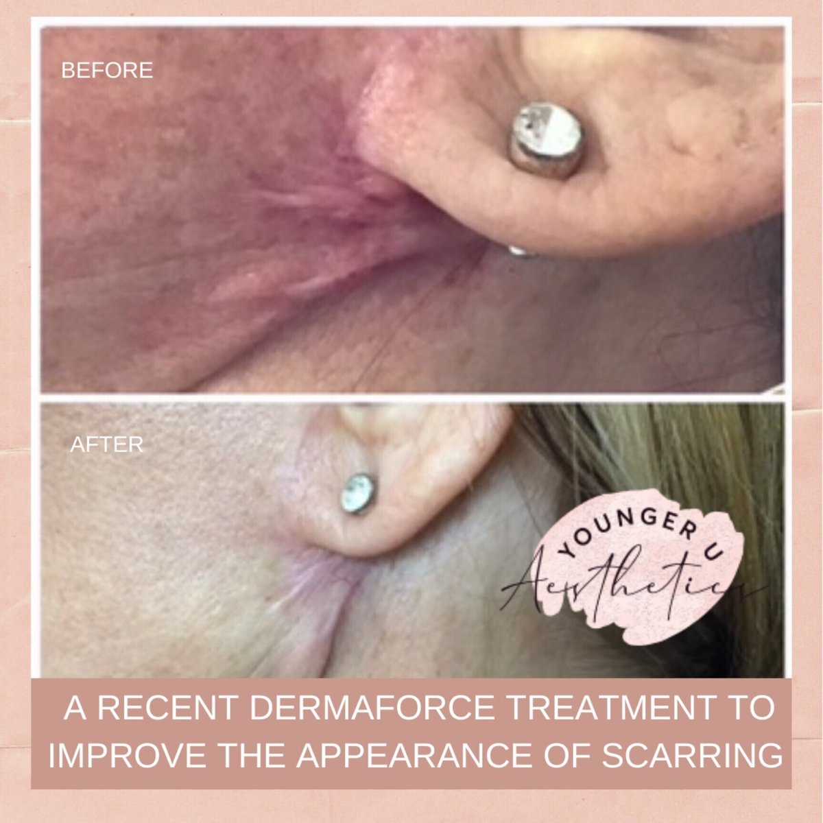 YUAesthetics's tweet photo. Another recent #beforeandafter picture of a recent treatment using #Dermaforce to reduce the appearance of #scarring.
Thank you so much to all of my patients who let me share their treatment images and who share their feedback through testimonials - it's very much appreciated! https://t.co/TFr0tLZ4ll