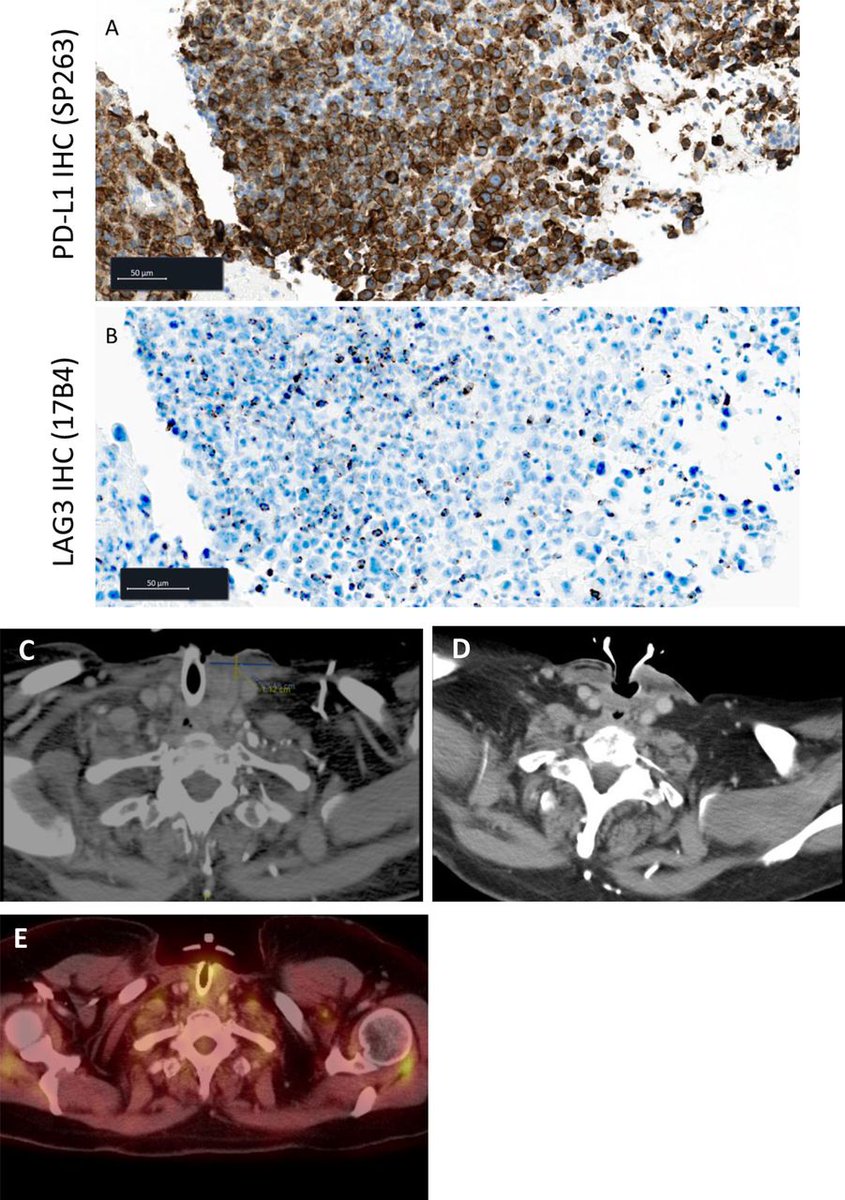 jitcancer's tweet photo. New #JITC case report: Durable response of anaplastic thyroid carcinoma to FS118, a bispecific LAG-3/PD-L1 antibody, after checkpoint inhibitor progression: a case report https://t.co/xZn6ALSJh0 https://t.co/nKXzqoWy9e