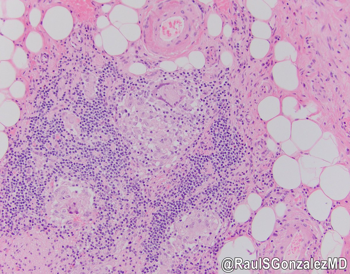 Sarcoidosis can strike anywhere -- even the appendix! #pathology #gipath #PathTwitter #PathOutPic