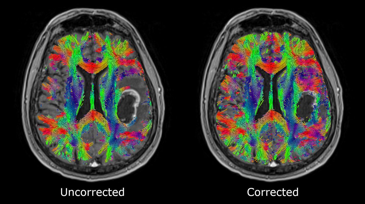 SynaptiveMed's tweet photo. Introducing Modus™ Plan with Reveal!
#SynaptiveMedical has launched its free water correction feature – Reveal - to enhance DTI #tractography use within our neurosurgical planning software, #ModusPlan . Click the link to learn more about this new feature. https://t.co/RgU8N7nt8n https://t.co/oi2Xhtr8yS