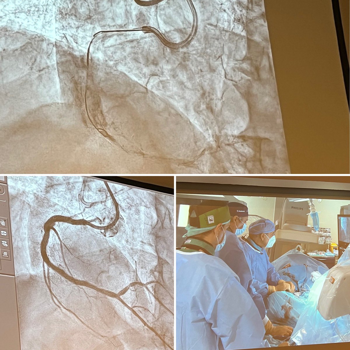 What I learnt from my first #CTO mentor, @MauroCarlino3, is that it’s hard to go against the mainstream belief system. Knuckles and intraCTO contrast injections. Damn the naysayers. Challenge the dogma. 💪🏼 #OMG2022 @ Cordoba 🇪🇸 @MPAOSS @OjedaOjeda18