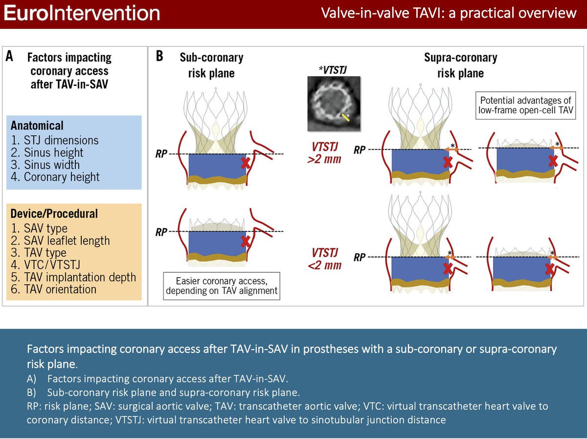 This Eurointervention State-of-the-Art provided a focused overview of the most significant periprocedural operative considerations for valve-in-valve transcatheter aortic valve implantation. @G_Tarantini01 @DvirDanny @GilbertTangMD #EIJBestOf #TAVI ow.ly/M2fs50L3m1r