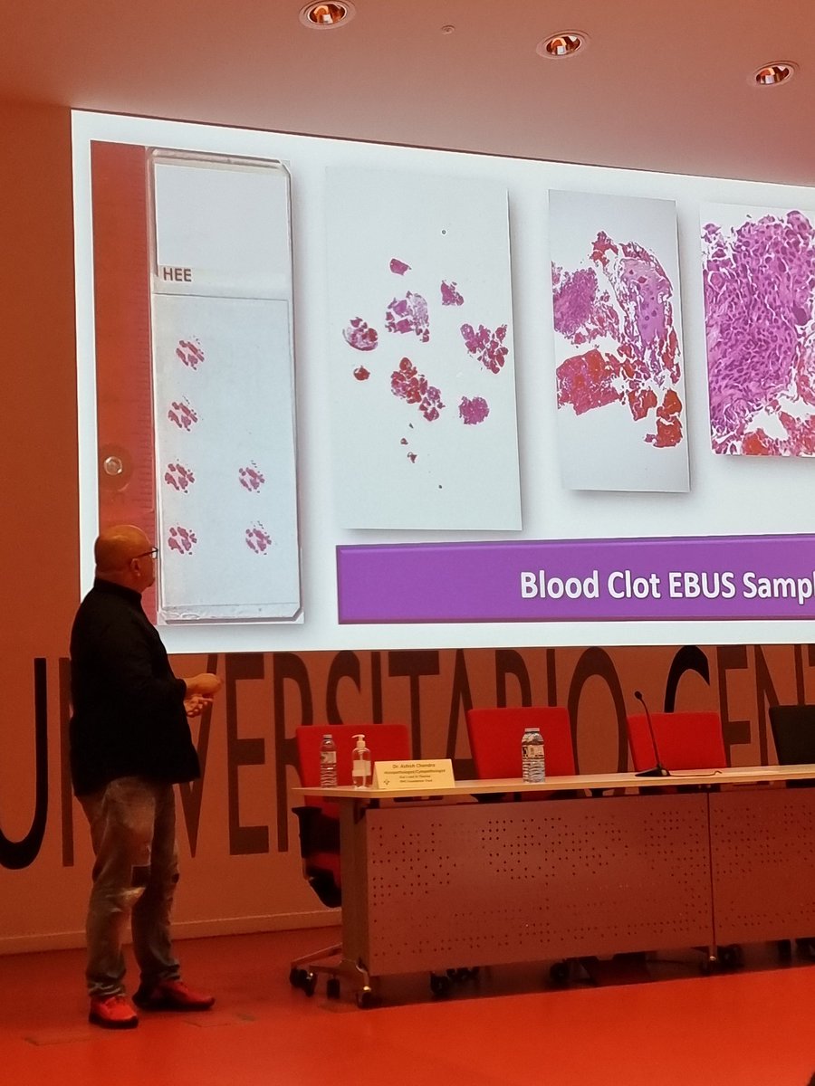 drpathcell's tweet photo. #PINA2022 Impressive clinical-pathological correlation with outstanding architectural features #MediastinalCRYOEBUS thanks to the best interventional pathologist @duckhuca @MiguelAriza83 @USFNA_SPAIN https://t.co/Gw55VIhBt8