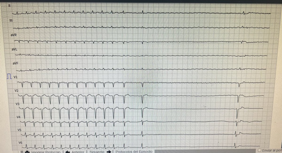 cardiohiba_resi's tweet image. Vamos con un quiz electrocardiografico:
Que ven en el siguiente ECG?

#Cardiotwitter #ECG #cardiobot