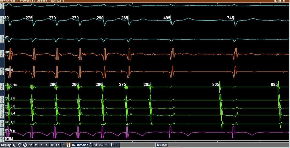 #EPeeps,What is the most likely explanation here? 
<a href="/EPeeps_Bot/">EP_Bot</a> <a href="/MattMelcherPA/">Matthew Melcher</a> <a href="/UlhasDr/">Dr Ulhas Pandurangi</a> <a href="/ALFIEEP1/">ALBERTO ALFIE</a> <a href="/dog_oculus/">Mtwesi.Viwe.MD</a> <a href="/bordistef/">Stefano Bordignon, EP</a> <a href="/SergioPinski/">Sergio Pinski</a> <a href="/adribaran/">Adrian Baranchuk MD FACC FRCPC FCCS FSIAC</a> <a href="/ELabartkava/">Eugene Labartkava</a> <a href="/EPWoodsShop/">Christopher Woods</a> <a href="/finnakerstrom/">Finn Åkerström</a> <a href="/javadm20/">javad mikaeili</a> <a href="/SchakrabartiEP/">Shanta Chakrabarti</a> <a href="/ShaojieChen1/">Shaojie Chen</a> <a href="/Doc_AleCuesta/">Alejandro Cuesta</a> <a href="/MaruanCarlos/">Maruan C Chabbar</a> <a href="/MartowMartow/">Evan Martow</a>