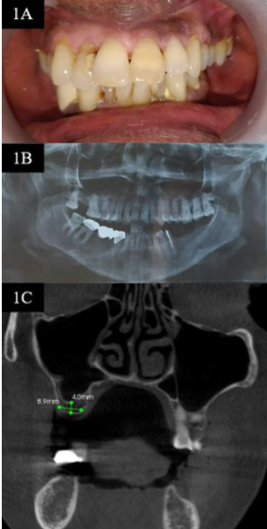 JCTR_ASP's tweet photo. Subantral #sinus #augmentation using a #hydraulic lift system and #alloplastic #phosphosilicate putty followed by simultaneous implant placement for the rehabilitation of an #atrophic posterior #maxilla: A case report
https://t.co/PiwI7tmzzw https://t.co/ZAcGRtD8zT