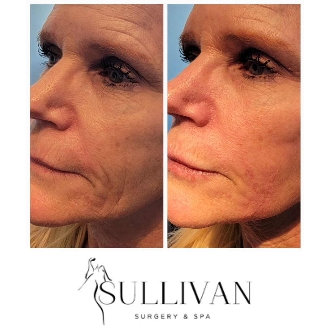 Sullivan1K's tweet photo. Before and after filler in fine lines around the mouth.

Here using the fern technique with small amounts of Restylane filler, the fine lines around the mouth soften and nearly disappear!

This is a great treatment to reduce the appearance of fine lines and restore a youthful app https://t.co/75jhTgFYbp