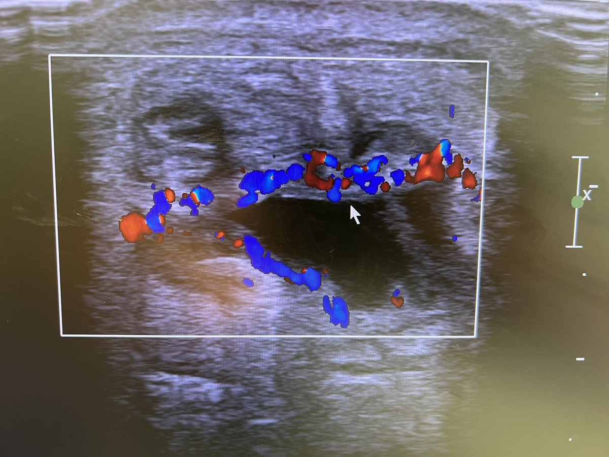 Cross section view of a retrocalcaneal bursa. 

Certainly a pain generator in its own right when this inflamed and usually associated with insertional TA tendinopathy but not always.

Palpate around base of tendon and over the RC bursa. DF of step usually provocs too.