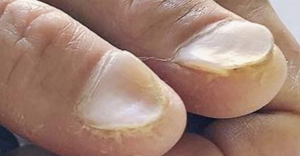 اظافر الملعقة

تدل على نقص بالحديد، او مرض مناعي، او سكري، او قلب، او كثرة حديد، او صدفية، او ذئبة، او غدة درقية

الكبد هو المسؤول عن الاظافر 

الكبد لا يحب الحلويات والغازيات والتدخين والمكملات وكثرة المنبهات 

اقطعوا الضرر واعملوا الحجامة ليتنفس الكبد