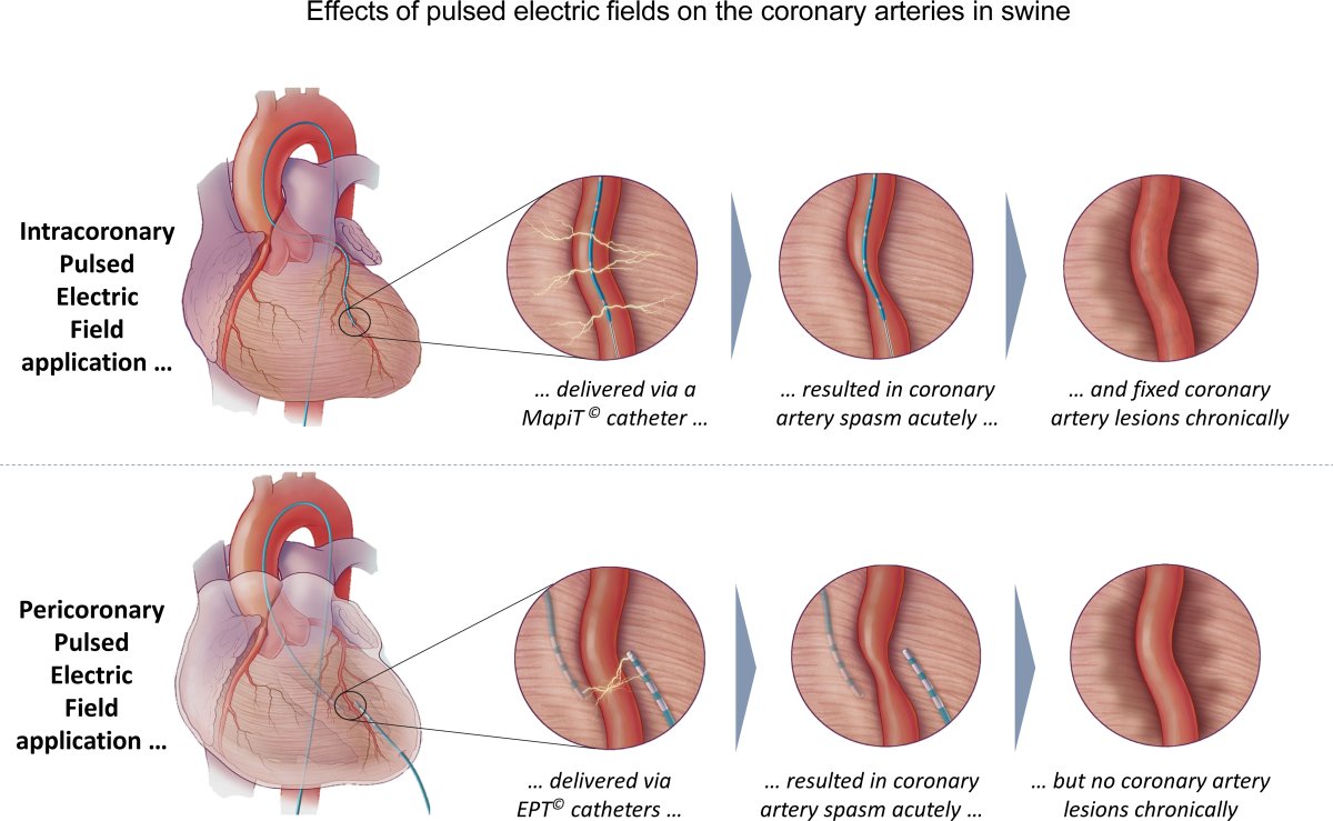 Mayo Electrophysiology Fellowship (@mayoepfellows) on Twitter photo Just out - PFA in or near coronary arteries. Intra-coronary PFA caused spasm and stenosis; only spasm seen with peri-coronary PFA. Link: ahajournals.org/doi/abs/10.116…
<a href="/MayoClinicCV/">Mayo Clinic CV</a> <a href="/MayoCVFellows/">Mayo Clinic Rochester Cardiology Fellows</a> <a href="/f_delcarpio/">Freddy Del-Carpio</a> <a href="/DrDeese99/">Christopher DeSimone, MD, PhD</a> <a href="/maor_elad/">Elad Maor</a> <a href="/akillumd/">Ammar Killu</a> <a href="/DrMvanZyl/">Martin van Zyl, MB BCh</a> <a href="/nicktanCV/">Nicholas Tan</a> #EPeeps Just out - PFA in or near coronary arteries. Intra-coronary PFA caused spasm and stenosis; only spasm seen with peri-coronary PFA. Link: ahajournals.org/doi/abs/10.116…
<a href="/MayoClinicCV/">Mayo Clinic CV</a> <a href="/MayoCVFellows/">Mayo Clinic Rochester Cardiology Fellows</a> <a href="/f_delcarpio/">Freddy Del-Carpio</a> <a href="/DrDeese99/">Christopher DeSimone, MD, PhD</a> <a href="/maor_elad/">Elad Maor</a> <a href="/akillumd/">Ammar Killu</a> <a href="/DrMvanZyl/">Martin van Zyl, MB BCh</a> <a href="/nicktanCV/">Nicholas Tan</a> #EPeeps