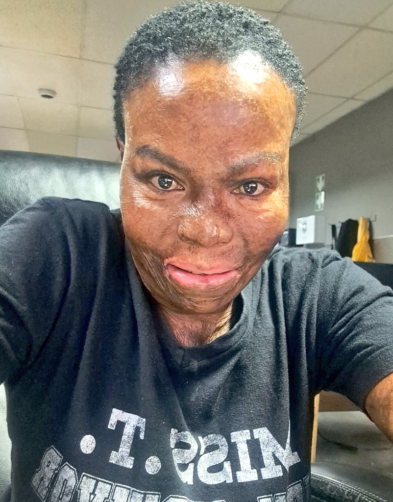 MissT 🇿🇦 Burn Survivor on Twitter "Good morning my beloved friends ️ 💕