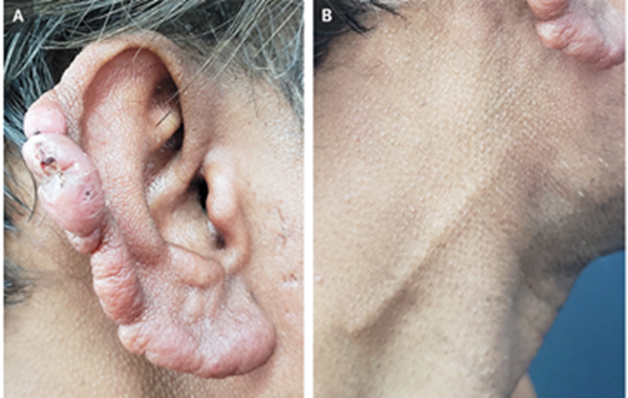 guerreroespejo's tweet photo. A 40-YO👨‍🦱: a 1-year of painless swelling of his earlobes; nasal congestion &amp; intermittent nosebleeds, indurated, contiguous nodules of both ears (A), thickening of the greater auricular nerve (B) on both sides &amp; patchy loss of sensation in arms &amp; legs
1/

#dermatology #IDtwitter https://t.co/vT6iAaOqep