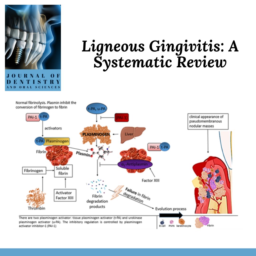 Ligneous Gingivitis: A Systematic Review

Read the full-length paper via following link: maplespub.com/article/polyla…

Submit your paper for next issue at dentistry@mapsci.org

#Dentistry #TissueRegeneration #Collagen