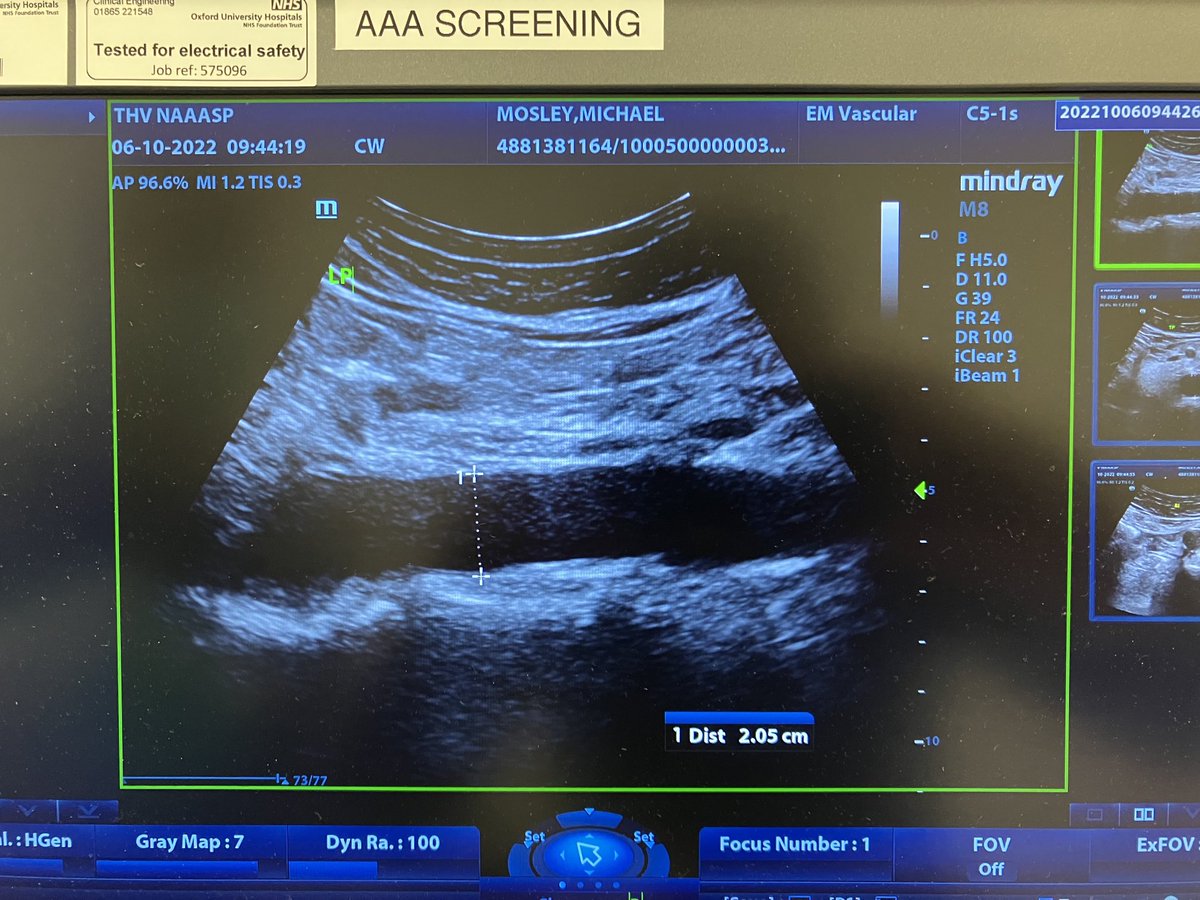 Isn’t this lovely? ultrasound scan, part of national abdominal aortic aneurysm screening programme. My aorta is long dark shape at the bottom.This test is designed to pick up weak, leaky aortas that can rupture and kill. Nearly happened to a friend recently. Being offered to 65+