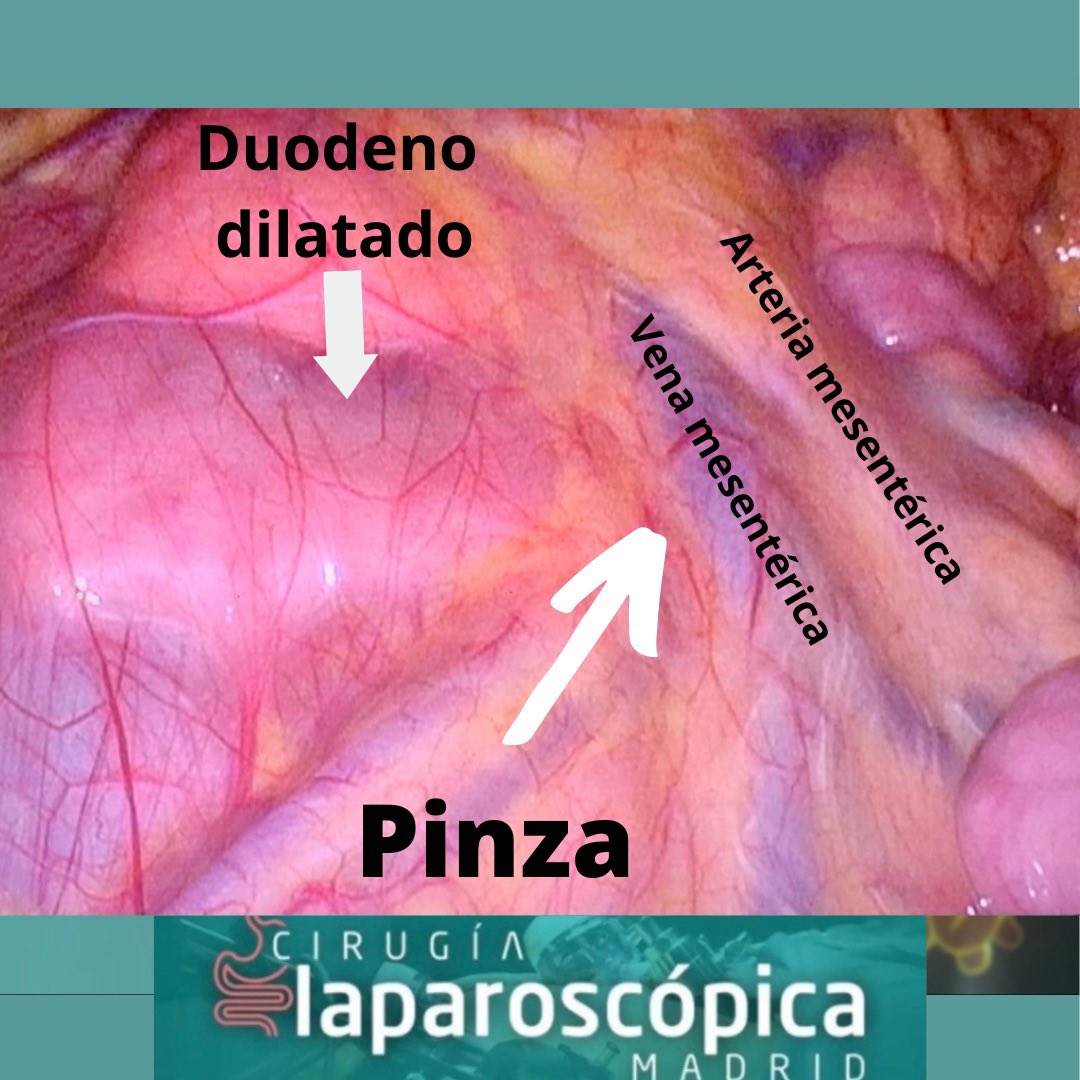 Compartimos la imagen de uno de nuestro últimos casos intervenidos por Sindrome de Wilkie
Se aprecia la dilatación de la porción horizontal del duodeno previa a la compresión que se produce entre  la aorta y la arteria mesentérica superior.#sindromedewilkie <a href="/viamedsalud/">Viamed Salud</a>