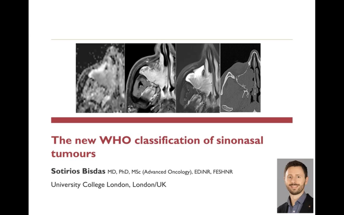 ESHNR (@eshnrsociety) on Twitter photo The first lecture of the ‘Sinonasal and nasopharyngeal tumours’ titled: ‘The new WHO classification of sinonasal tumours’ by S. Bisdas <a href="/SBisdas/">Sotirios Bisdas</a>, Richmond/UK #ESHNR22 #HNrad
<a href="/myESR/">myesr</a> <a href="/BSHNI_UK/">British Society of Head & Neck Imaging</a> <a href="/ASHNRSociety/">ASHNR</a> The first lecture of the ‘Sinonasal and nasopharyngeal tumours’ titled: ‘The new WHO classification of sinonasal tumours’ by S. Bisdas <a href="/SBisdas/">Sotirios Bisdas</a>, Richmond/UK #ESHNR22 #HNrad
<a href="/myESR/">myesr</a> <a href="/BSHNI_UK/">British Society of Head & Neck Imaging</a> <a href="/ASHNRSociety/">ASHNR</a>