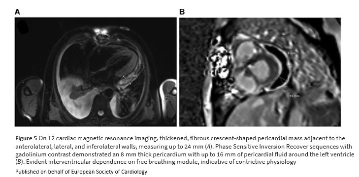European Society of Cardiology Journals (@esc_journals) on Twitter photo Early-onset post-cardiotomy severe constrictive pericarditis academic.oup.com/ehjcr/article/…
#EHJCaseReports <a href="/aayshacader/">Aaysha Cader</a> <a href="/ANazmiCalik/">A.Nazmi Calik</a> <a href="/KardiologieHH/">Erik Rafflenbeul</a> <a href="/EHJCREiC/">EHJCaseReports Editor-in-Chief</a> <a href="/TJ_Yeo/">Tee Joo YEO</a> <a href="/cfcamm/">Fielder Camm</a> <a href="/FarhanaAra/">Farhana</a> #YesCCT #EchoFirst #ImageFirst #wyhCMR Early-onset post-cardiotomy severe constrictive pericarditis academic.oup.com/ehjcr/article/…
#EHJCaseReports <a href="/aayshacader/">Aaysha Cader</a> <a href="/ANazmiCalik/">A.Nazmi Calik</a> <a href="/KardiologieHH/">Erik Rafflenbeul</a> <a href="/EHJCREiC/">EHJCaseReports Editor-in-Chief</a> <a href="/TJ_Yeo/">Tee Joo YEO</a> <a href="/cfcamm/">Fielder Camm</a> <a href="/FarhanaAra/">Farhana</a> #YesCCT #EchoFirst #ImageFirst #wyhCMR